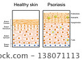 Psoriasis. Comparison of healthy skin epidermis and psoriatic skin structure. 138071113