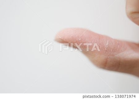 A close-up showing skin problems on a dry thumb. A close-up showing skin problems on a dry thumb. 138071974