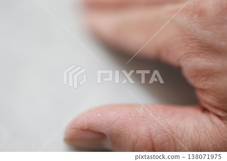 A close-up showing skin problems on a dry thumb. A close-up showing skin problems on a dry thumb. 138071975