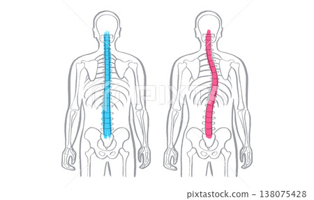 Scoliosis spine deformity Scoliosis spine deformity 138075428