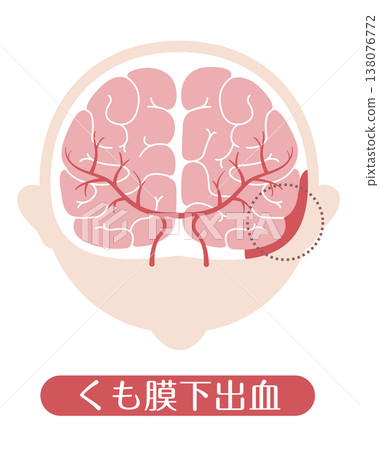Subarachnoid hemorrhage (medical illustration) 138076772