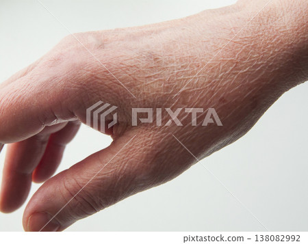 Senior woman hand aging symptoms, dry thin skin on back of hand, dehydration and vitamin deficiency. 138082992