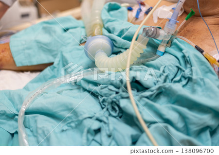 Close up of ventilator tubing and connectors on patient in hospital highlighting critical care respiratory support medical treatment monitoring and clinical environment with soft fabric Close up of ventilator tubing and connectors on patient in hospital highlighting critical care respiratory support medical treatment monitoring and clinical environment with soft fabric 138096700