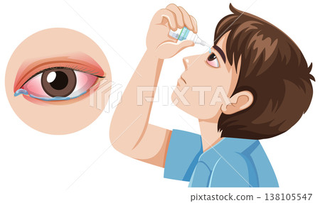 Boy Using Eye Drops for Red Irritated Eye 138105547