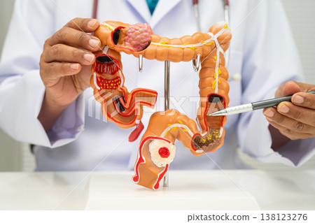 Colorectal cancer, doctor holding intestine colon human anatomy model. 138123276