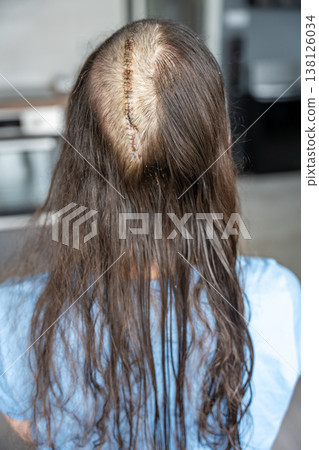 Back view of woman with surgical scar after brain tumor removal surgery. Craniotomy and meningioma treatment concept. Back view of woman with surgical scar after brain tumor removal surgery. Craniotomy and meningioma treatment concept. 138126034