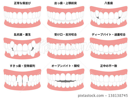 牙齒排列與咬合示意圖 牙齒排列與咬合示意圖 138138745