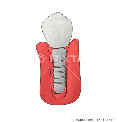 Illustration of dental implant 138144738