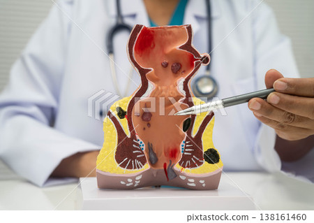 Asian doctor with rectum and hemorrhoid human model, inflamed vascular structure. 138161460