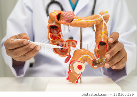 Colorectal cancer, doctor holding intestine colon human anatomy model. 138163159