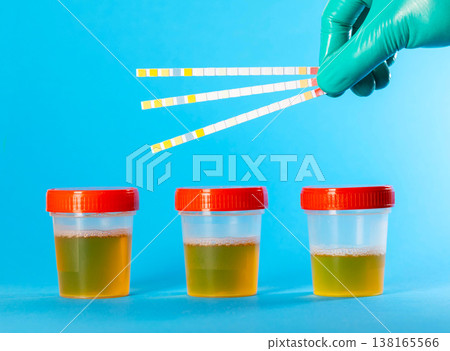 A doctor holds rapid test strips against a blue background, next to a three-cup urine sample. Conceptual illustration of a urine test for nitrites, protein, and acidity, close-up A doctor holds rapid test strips against a blue background, next to a three-cup urine sample. Conceptual illustration of a urine test for nitrites, protein, and acidity, close-up 138165566