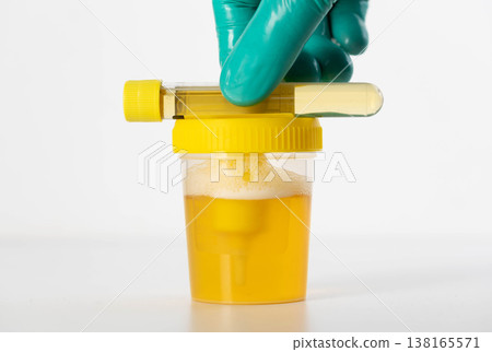 A laboratory technician's hand holds a test tube with urine for testing for bacterial culture and infections causing inflammation in the genitourinary system. Copy space for text A laboratory technician's hand holds a test tube with urine for testing for bacterial culture and infections causing inflammation in the genitourinary system. Copy space for text 138165571