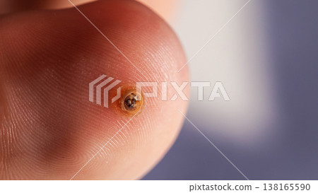 Verruca On Toe With Focused Lighting. A Macro Photograph Details The Skin Condition. Verruca On Toe With Focused Lighting. A Macro Photograph Details The Skin Condition. 138165590