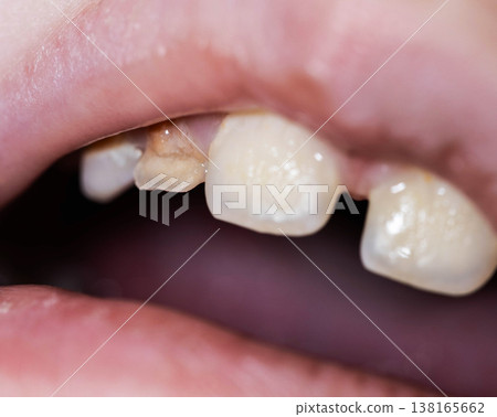 Close-up view showing milk teeth of a child with clear signs of enamel hypoplasia and damage, highlighting a common pediatric dental condition. 138165662