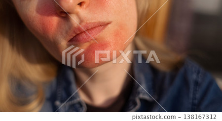 Rosacea and couperosis of the skin. The girl suffers from redness on her cheeks or sunburn symptoms. Redness and capillary mesh are visible on the face. Vascular surgery and dermatology 138167312