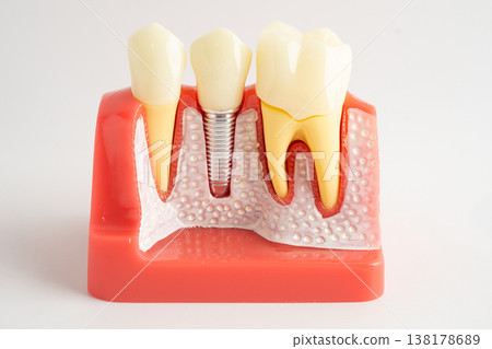 Dental implant, artificial tooth roots into jaw isolated on white background with clipping path. Dental implant, artificial tooth roots into jaw isolated on white background with clipping path. 138178689