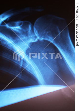 Shoulder bone imagery. Advanced imaging displays subtle fracture in shoulder region clearly 138186078