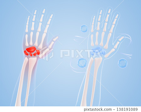3D hand bone anatomy - red wrist pain and healthy arm with blue gel ointment drops. Medical carpal comparison with red inflammation and pharmaceutical drugs for orthopedic treatment. 3D illustration 3D hand bone anatomy - red wrist pain and healthy arm with blue gel ointment drops. Medical carpal comparison with red inflammation and pharmaceutical drugs for orthopedic treatment. 3D illustration 138191089