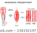 Myofascial trigger point in leg. Muscle fibers with contracture knots and taut band 138192197