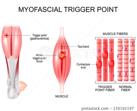Myofascial trigger point in leg. Muscle fibers with contracture knots and taut band 138192197