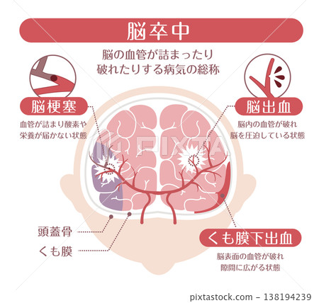 圖示比較不同類型的中風（腦梗塞、腦出血、蜘蛛網膜下腔出血） 138194239