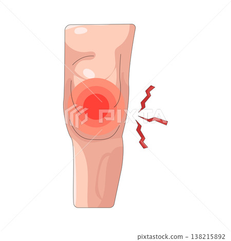 Illustration of knee pain Illustration of knee pain 138215892