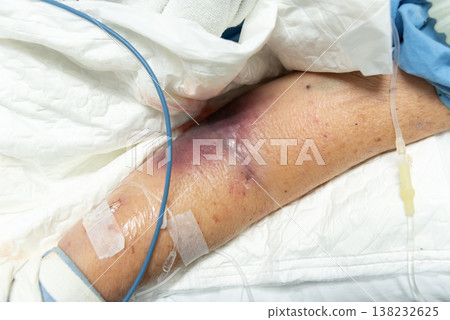 elderly arm with bruising and intravenous line showing medical treatment injury recovery and healthcare monitoring in clinical environment closeup detail elderly arm with bruising and intravenous line showing medical treatment injury recovery and healthcare monitoring in clinical environment closeup detail 138232625