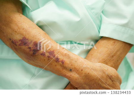Ecchymosis, elderly bleeding on her arm after taking aspirin. Ecchymosis, elderly bleeding on her arm after taking aspirin. 138234433