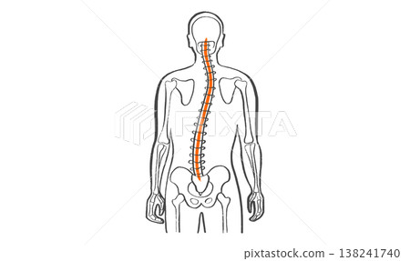 Scoliosis spine deformity Scoliosis spine deformity 138241740