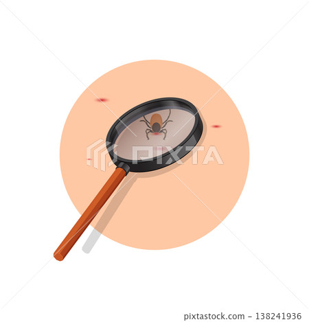 Removing encephalitis ticks after bite. How to remove mite. Parasite carrying disease.Using magnifying glass to find ticks. Removing encephalitis ticks after bite. How to remove mite. Parasite carrying disease.Using magnifying glass to find ticks. 138241936