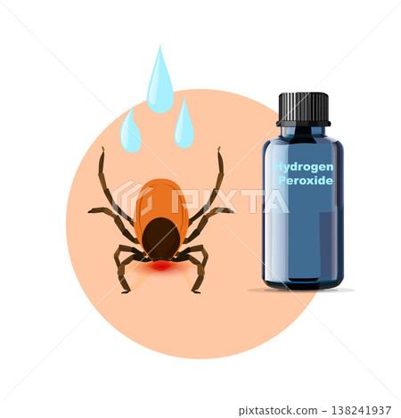 Removing encephalitis ticks after bite. How to remove mite. Parasite carrying disease.Disinfect with hydrogen peroxide. 138241937