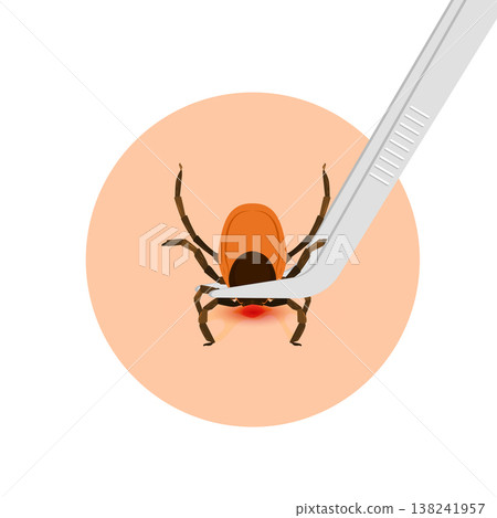 Removing encephalitis ticks after bite. How to remove mite. Parasite carrying disease. 138241957
