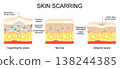 Skin scarring. Comparison of Normal skin surface, Hypertrophic and Atrophic scars 138244385
