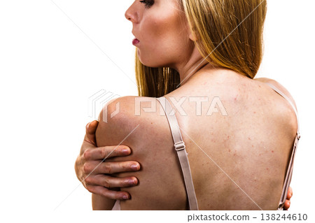 Woman with skin problem acne on back Woman with skin problem acne on back 138244610