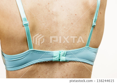 Woman with acne pimple on back. 138244615