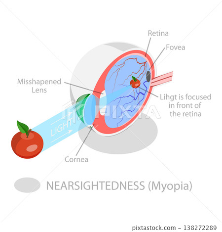3D Isometric Flat Vector Illustration of Vision Disorder, Far-Sightedness And Near-Sightedness Anatomical Diagram. Item 1 3D Isometric Flat Vector Illustration of Vision Disorder, Far-Sightedness And Near-Sightedness Anatomical Diagram. Item 1 138272289