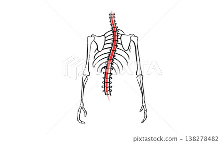 Scoliosis spine deformity Scoliosis spine deformity 138278482