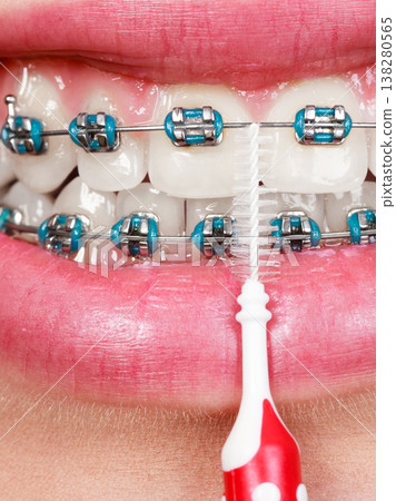 Woman brushing teeth with braces using brush 138280565