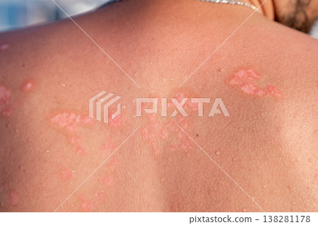 Psoriasis Patches on a Persons Back Observed During a Sunny Day at the Beach in a Coastal Location Psoriasis Patches on a Persons Back Observed During a Sunny Day at the Beach in a Coastal Location 138281178