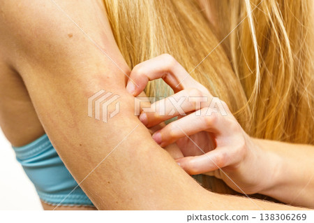 Woman scratching her itchy arm. Skin allergy. 138306269