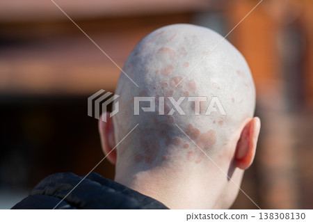 Back view of bald man with psoriasis on scalp. Skin rash and inflammation on head. Medical condition, autoimmune disease, dermatology and health problem concept for patients. 138308130