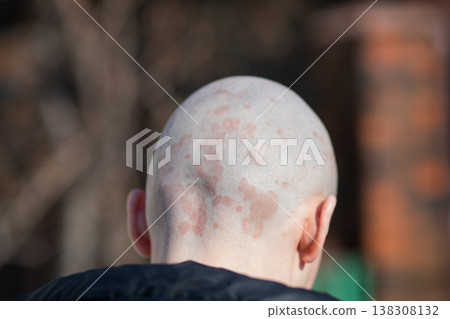 Back view of bald man with psoriasis on scalp. Skin rash and inflammation on head. Medical condition, autoimmune disease, dermatology and health problem concept for patients. Back view of bald man with psoriasis on scalp. Skin rash and inflammation on head. Medical condition, autoimmune disease, dermatology and health problem concept for patients. 138308132