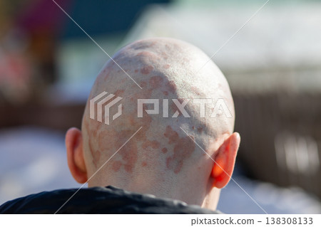 Man with psoriasis on the back of his scalp. Skin disease inflammation and dry red patch on head. Dermatological condition and health issue. Diagnosis of chronic autoimmune disorder. Man with psoriasis on the back of his scalp. Skin disease inflammation and dry red patch on head. Dermatological condition and health issue. Diagnosis of chronic autoimmune disorder. 138308133