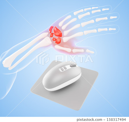 3d wrist pain - arm hand bones with red inflammation glow at joint area and office or gamer mouse on blue background. CTS carpal tunnel syndrome, tendon stress for medical treatment. 3D illustration 3d wrist pain - arm hand bones with red inflammation glow at joint area and office or gamer mouse on blue background. CTS carpal tunnel syndrome, tendon stress for medical treatment. 3D illustration 138317494