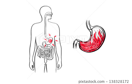 Gastroesophageal reflux pain 138328172