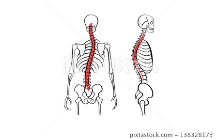 Scoliosis spine deformity Scoliosis spine deformity 138328173