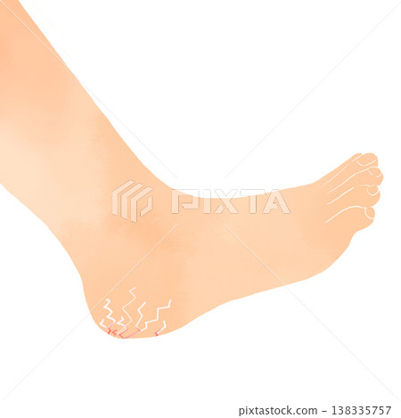 Illustration of cracked heels, watercolor style, representing dryness, rough skin, and skin problems. Illustration of cracked heels, watercolor style, representing dryness, rough skin, and skin problems. 138335757