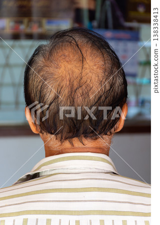 Back view of man with thinning hair and visible scalp showing hair loss pattern aging condition and dermatology concern with natural indoor background and copy space 138338413
