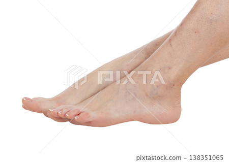 Female feet with vascular stars on the skin, isolated Female feet with vascular stars on the skin, isolated 138351065