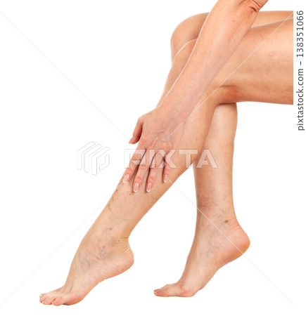 Female legs with vascular stars on the skin, isolated. Woman touches her shin with her hand Female legs with vascular stars on the skin, isolated. Woman touches her shin with her hand 138351066